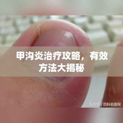 甲沟炎治疗攻略,有效方法大揭秘